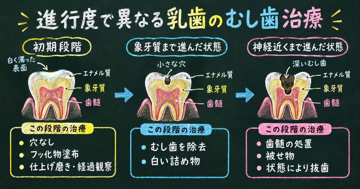 進行度で異なる乳歯のむし歯の治療内容